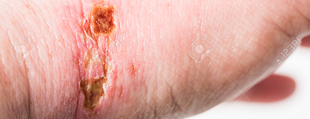 chemical burn