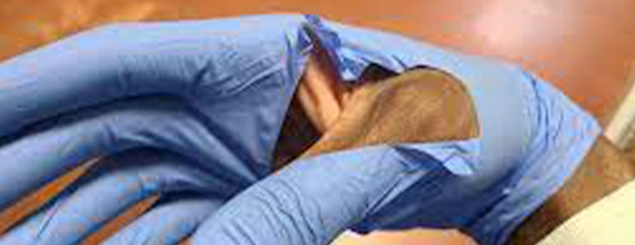 torn glove